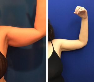 Minimally Invasive Arm Liposuction 2