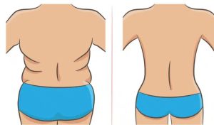 Back Liposuction Your Ultimate Results And Care Guide 825x510