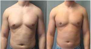 Before And After Gynecomastia