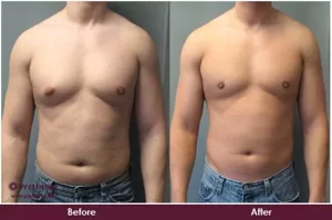 Before And After Gynecomastia