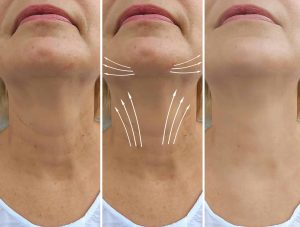 Neck Lift Full Process Scaled
